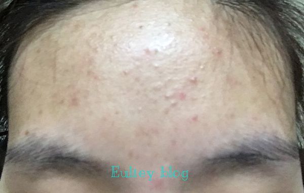 AMIINO安美諾高效抗痘凝膠