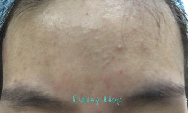 AMIINO安美諾高效抗痘凝膠