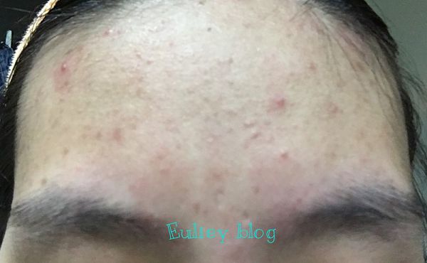 AMIINO安美諾高效抗痘凝膠