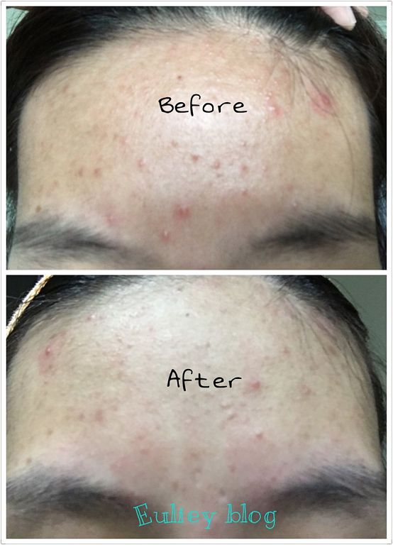 AMIINO安美諾高效抗痘凝膠