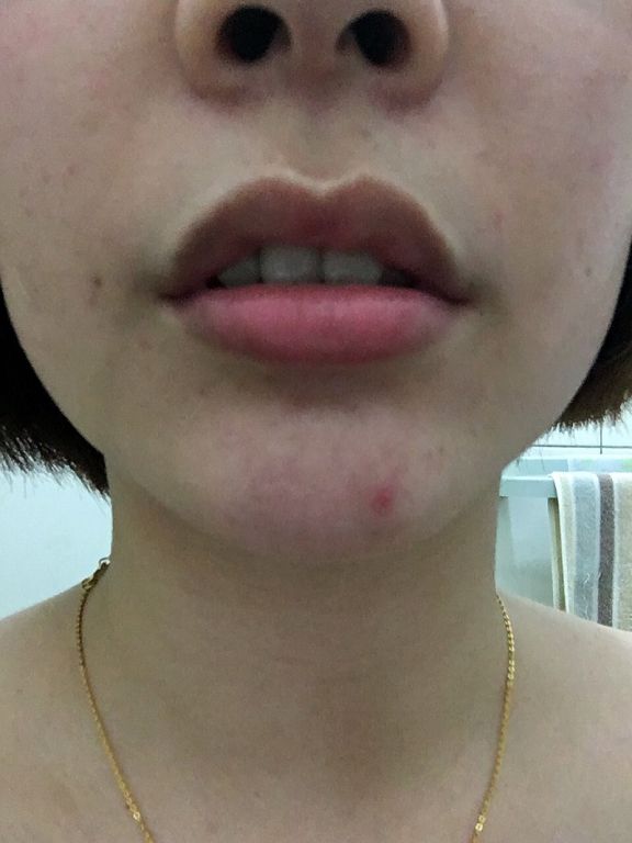 AMIINO安美諾高效抗痘凝膠