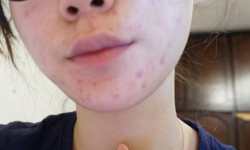 AMIINO安美諾高效抗痘凝膠