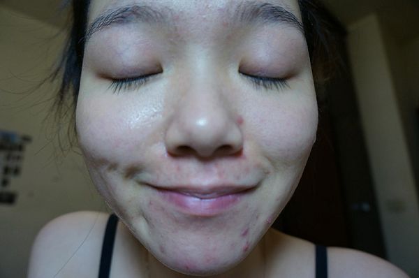 AMIINO安美諾高效抗痘凝膠