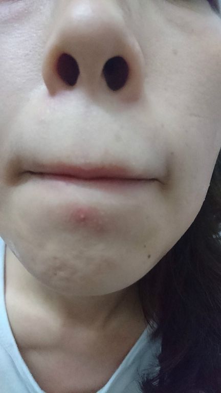 AMIINO安美諾高效抗痘凝膠