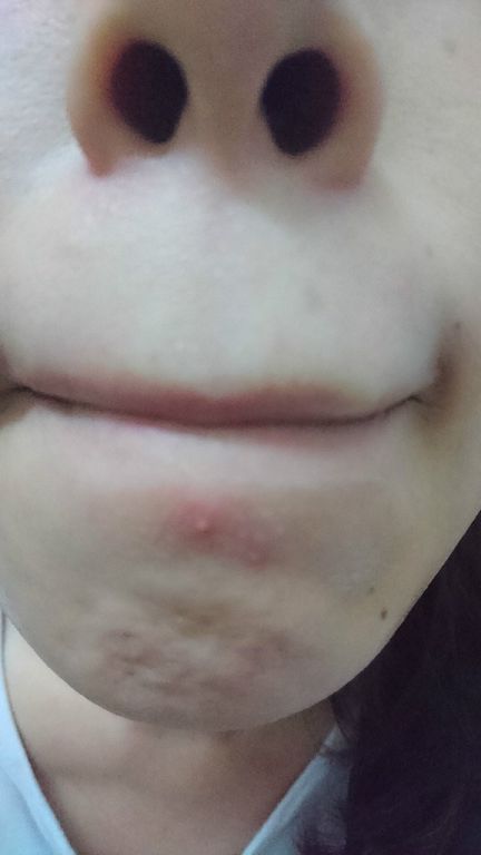 AMIINO安美諾高效抗痘凝膠