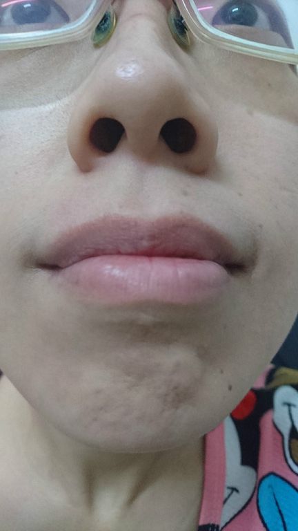 AMIINO安美諾高效抗痘凝膠